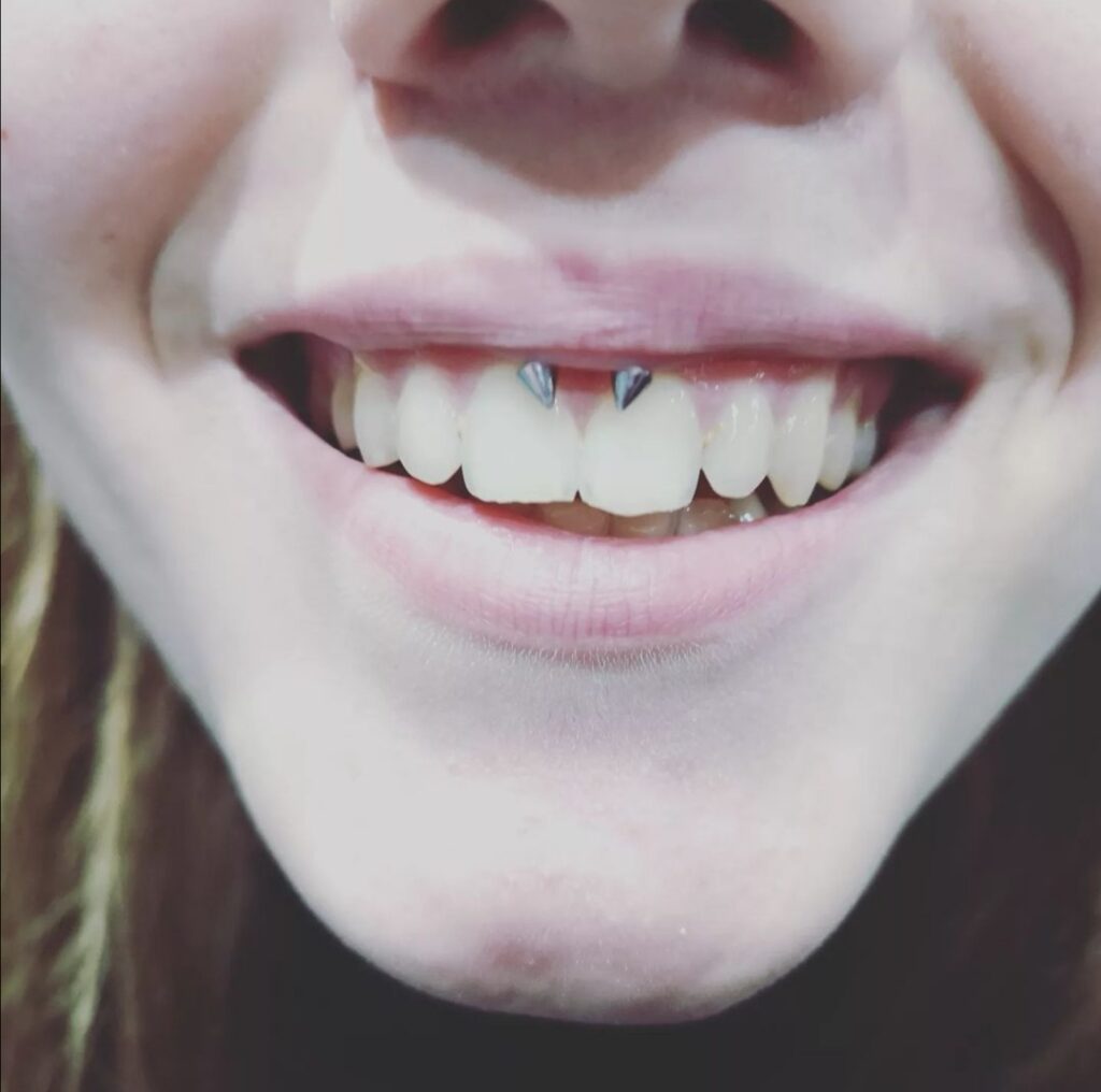 Smiley piercing