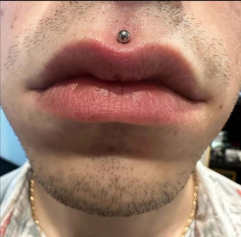 Medusa piercing